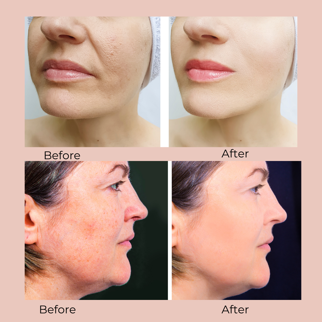 Just Glow! Light Therapy Face Mask